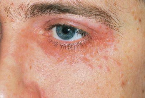 атопический дерматит симптомы на лице фото