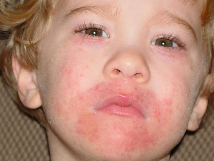 периоральный дерматит лечение у детей