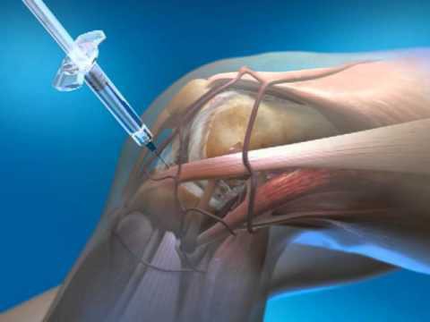 Какие уколы помогают при артрите thumbnail