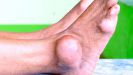 Подагрический артрит голеностопного сустава диагностика