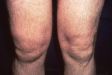Отек над коленом при артрите
