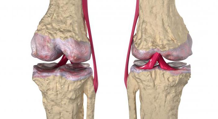 Ревматоидный артрит коленного сустава лечение