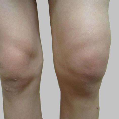 Ревматоидный артрит коленного сустава симптомы и лечение