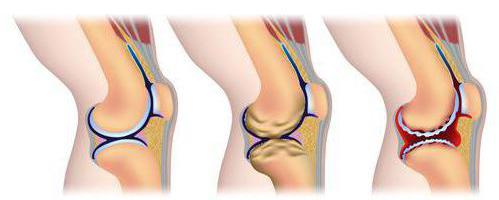 Ревматоидный артрит коленного сустава у детей