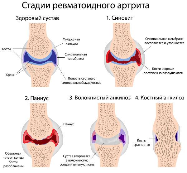 Ревматоидный артрит коленного сустава фото