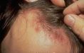 Уход за кожей при дерматитах кожи головы