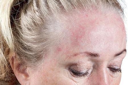Как быстро вылечить себорейного дерматита волосистой части головы thumbnail
