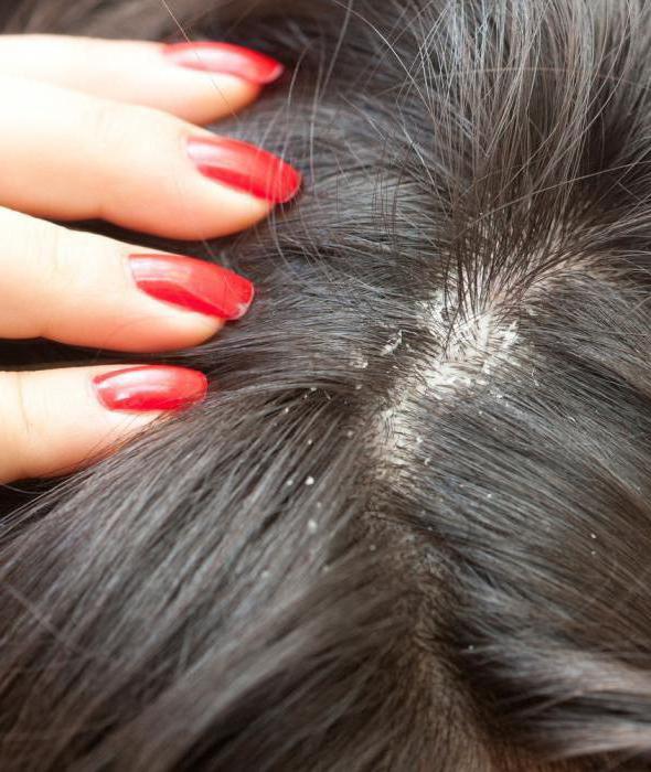 Что такое себорейный дерматит волос thumbnail