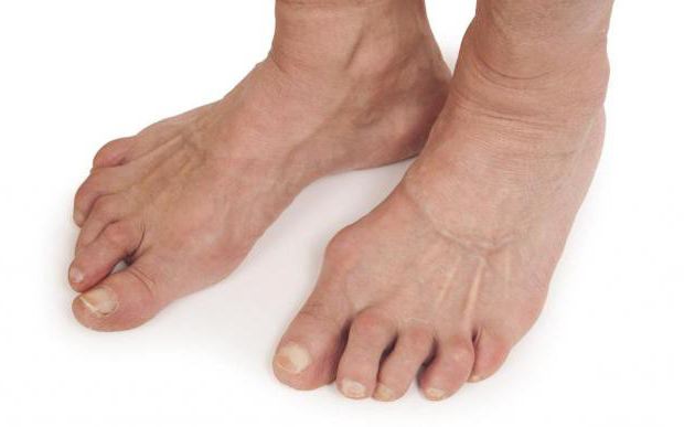 Как вылечить артрит сустава ноги thumbnail