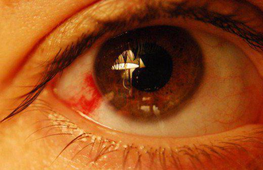 гематома глаза последствия