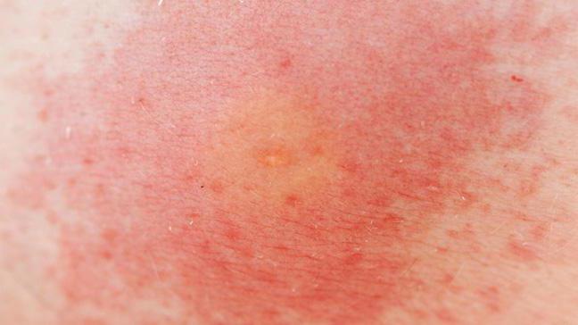 Что такое дерматит и как ней заражаются thumbnail