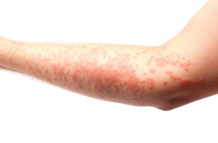 Что такое дерматит заразен ли он thumbnail