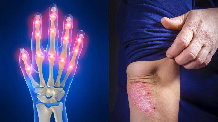 Причины и факторы риска ревматоидного артрита thumbnail