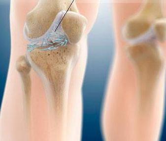 Как лечить подагрический артрит коленного сустава thumbnail