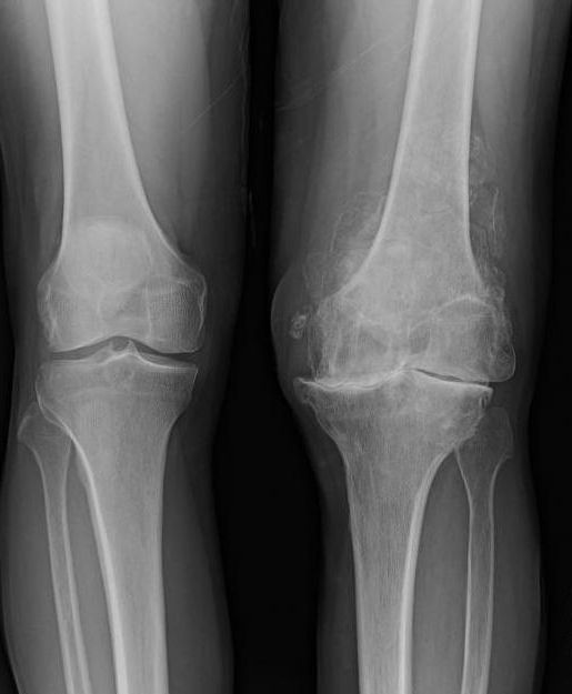Воспаление коленного сустава при подагре thumbnail