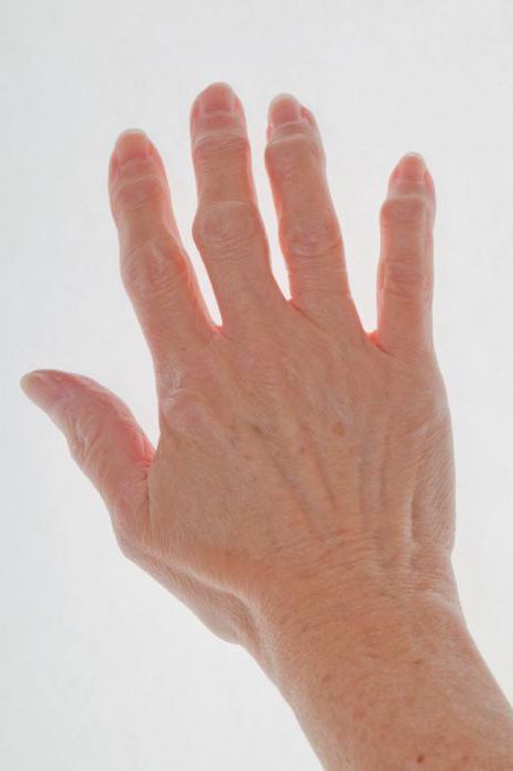 Чем мазать артрит пальцев рук thumbnail