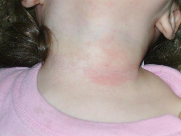 Аллергический дерматит на лице и шее фото thumbnail