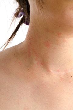 Атопический дерматит на шее у взрослого фото thumbnail