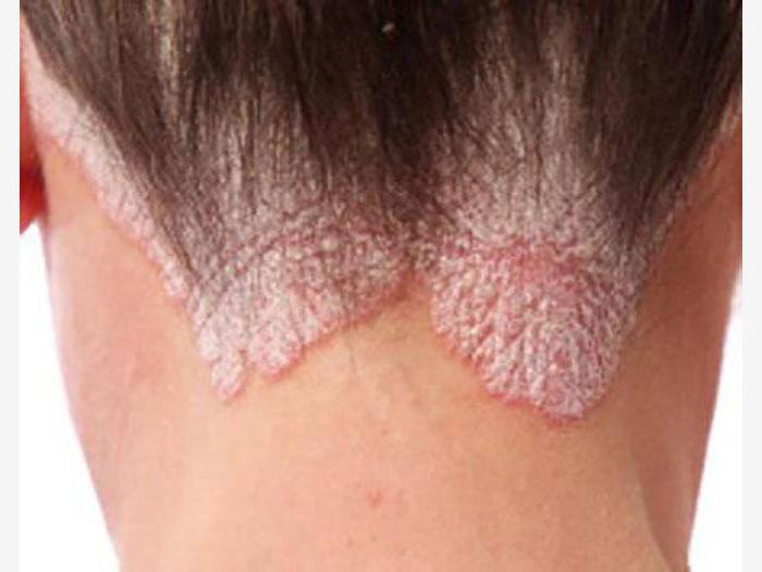 Чем лечить дерматит на шее под волосами thumbnail