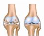 Лечение артрита коленного сустава в домашних условиях отзывы