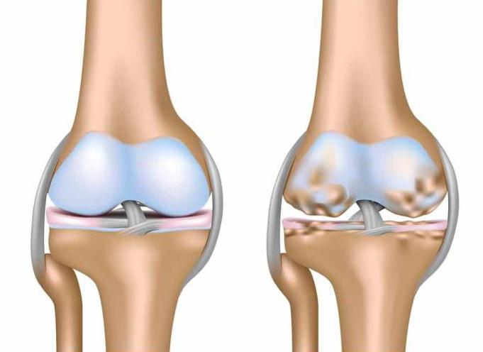 Лечение коленного сустава народными средствами отзывы thumbnail