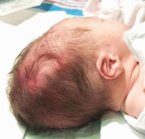 У новорожденного гематома на голове после родов: причины, лечение, последствия thumbnail