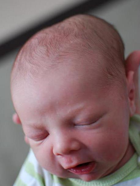 Гематомы при родах на голове у новорожденных thumbnail