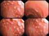 Лимфоидные фолликулы в желудке лечение thumbnail
