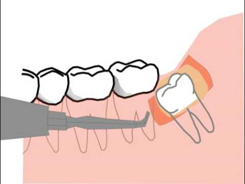 Гематома после удаления зуба мудрости лечение в домашних условиях thumbnail