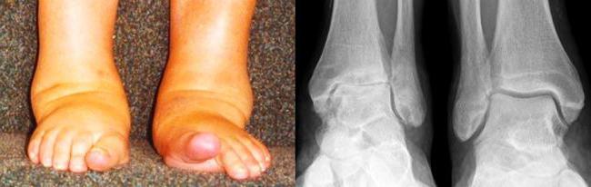 Ревматоидный артрит голеностопного сустава симптомы и лечение фото thumbnail