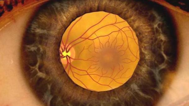 Гипертоническая ангиопатия обоих глаз лечение thumbnail
