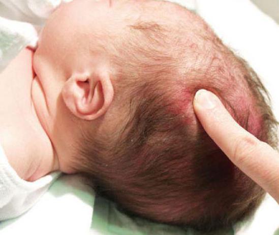 Гематома на голове у младенца после падения thumbnail