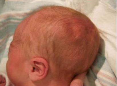 Ребенок гематома на голове thumbnail