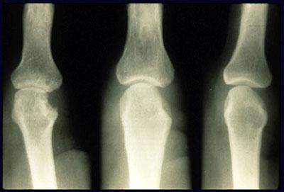 Рентгенологическая стадии ревматоидного артрита thumbnail