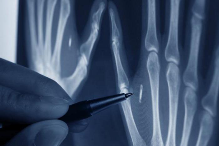 Лучевая диагностика ревматоидного артрита thumbnail