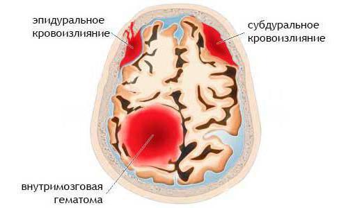 Оперативное лечение гематомы мозга thumbnail
