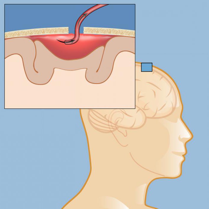 Период восстановления после удаления гематомы головного мозга thumbnail