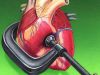 Гипертоническая болезнь с преимущественным поражением сердца