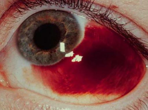 Гематома на глазу после удара лечение фото thumbnail