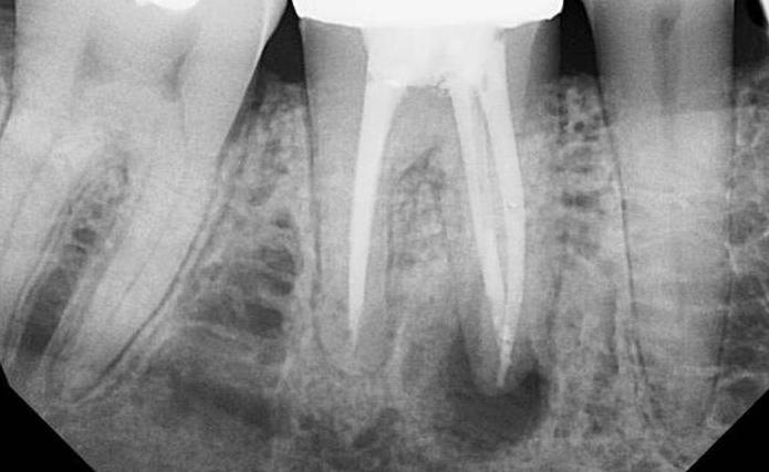 удаление зуба с гранулемой последствия 