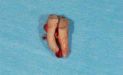 Сколько болит зуб после удаления гранулемы