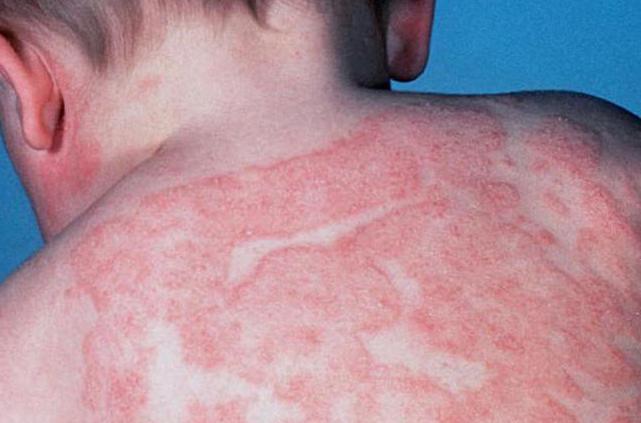 Лечение атопического дерматита у ребенка народными средствами thumbnail