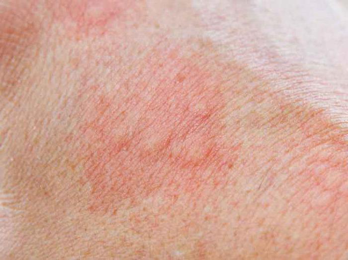 Аллергический дерматит по типу экземы thumbnail