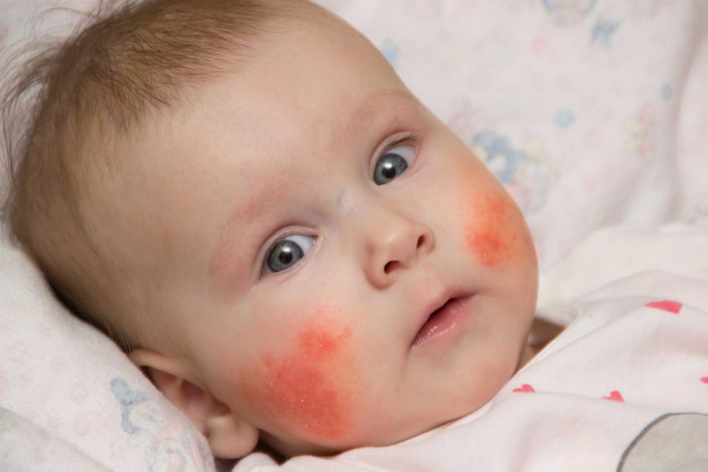 дерматит у младенца
