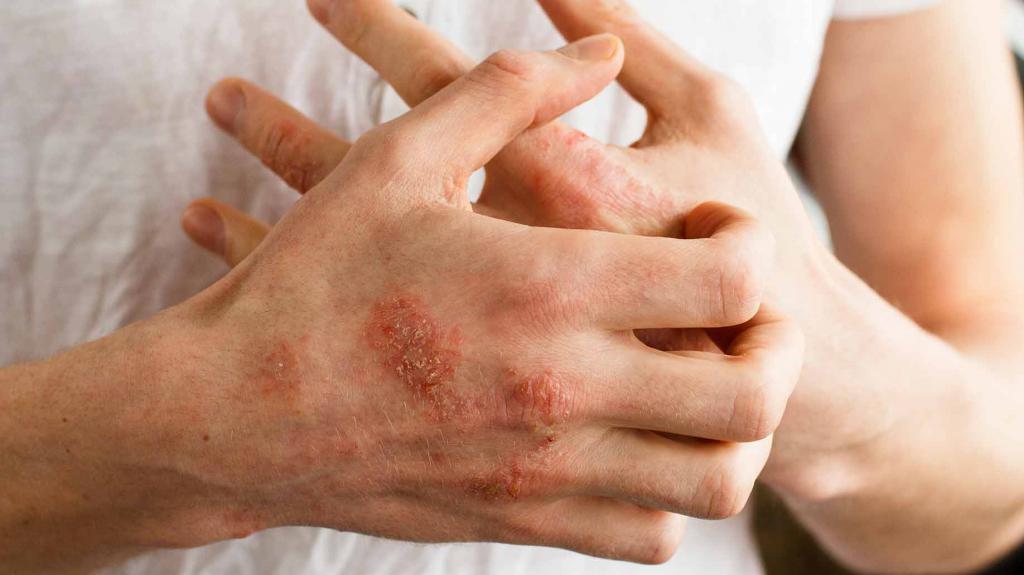 Лечение народными средством дерматита thumbnail
