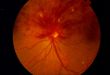Тромбоз сетчатки глаза лечение препараты
