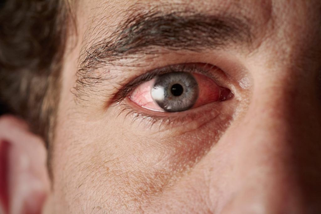 тромбоз ветви центральной вены сетчатки глаза
