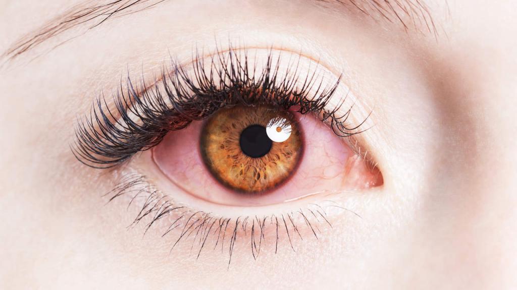 Красные уголки глаза причины и лечение thumbnail