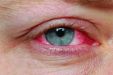 Хронический конъюнктивит глаз лечение отзывы
