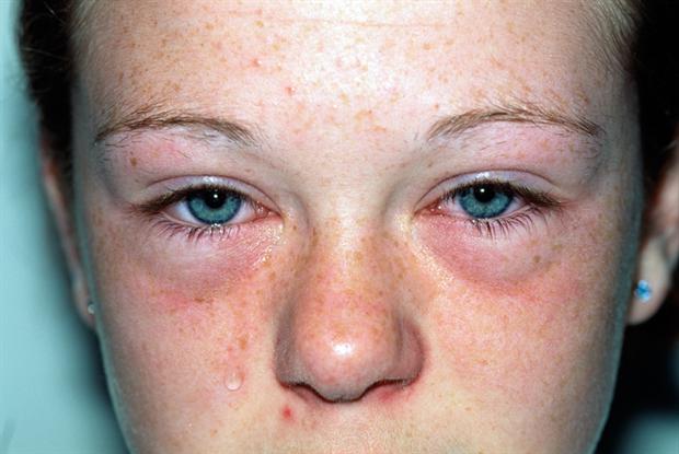 На что может быть аллергия летом когда слезятся глаза и чешется нос thumbnail